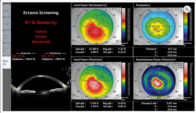 Fonction ECTASIA SCREENING-ophtalmologies-tunisia-freedom