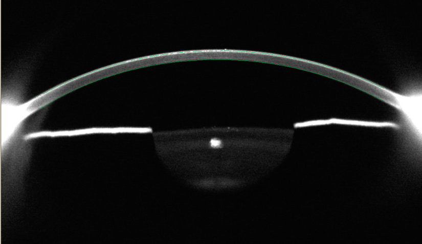 Imagerie Scheimpflug sans contrainte-ophtalmologies-tunisia-freedom-medicale