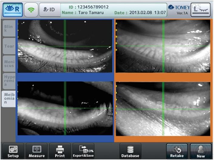 Meibographie-ophtalmologies-tunisia-freedom
