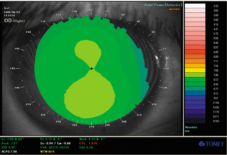 Topographie de courbure-ophtalmologies-tomey-tunisia-freedom-company
