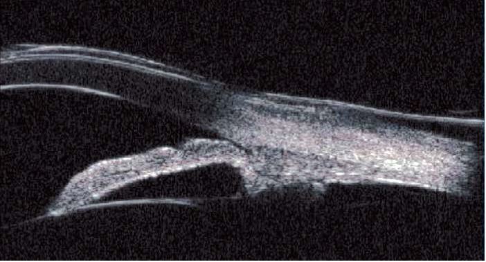 Visualisation avec la sonde UMB 60 MHz-echographies