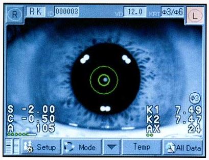 centrage-automatique-ophtalmologies-tunisia--freedom